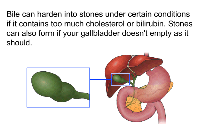 Bile can harden into stones under certain conditions if it contains too much cholesterol or bilirubin. Stones can also form if your gallbladder doesn't empty as it should.