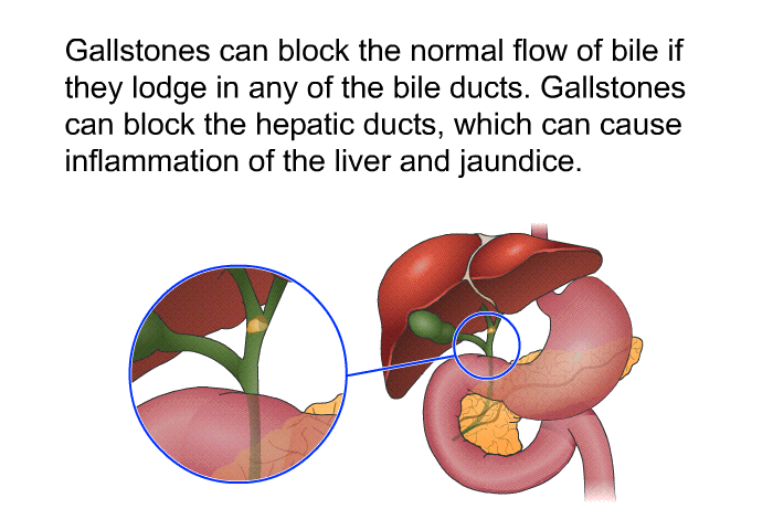 Gallstones can block the normal flow of bile if they lodge in any of the bile ducts. Gallstones can block the hepatic ducts, which can cause inflammation of the liver and jaundice.