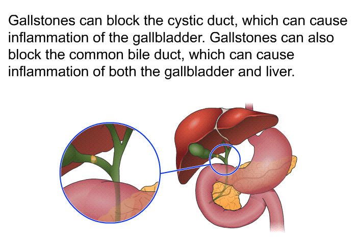 Gallstones can block the cystic duct, which can cause inflammation of the gallbladder. Gallstones can also block the common bile duct, which can cause inflammation of both the gallbladder and liver.