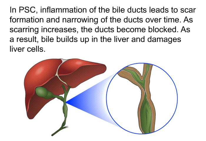 In PSC, inflammation of the bile ducts leads to scar formation and narrowing of the ducts over time. As scarring increases, the ducts become blocked. As a result, bile builds up in the liver and damages liver cells.