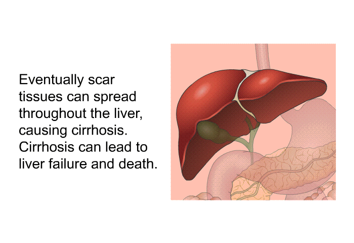 Eventually scar tissues can spread throughout the liver, causing cirrhosis. Cirrhosis can lead to liver failure and death.