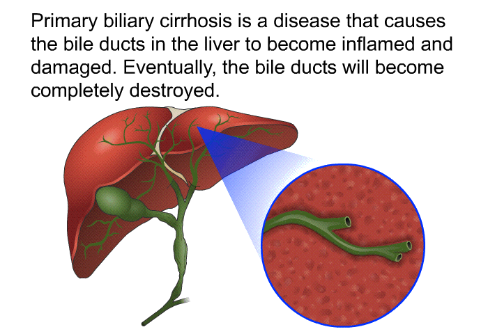 Primary biliary cirrhosis is a disease that causes the bile ducts in the liver to become inflamed and damaged. Eventually, the bile ducts will become completely destroyed.