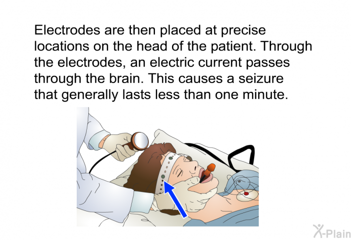 Electrodes are then placed at precise locations on the head of the patient. Through the electrodes, an electric current passes through the brain. This causes a seizure that generally lasts less than one minute.