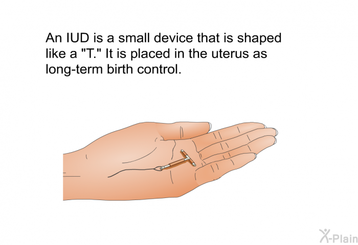 An IUD is a small device that is shaped like a “T.” It is placed in the uterus as long-term birth control.