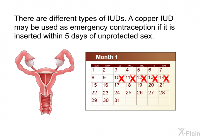 There are different types of IUDs. A copper IUD may be used as emergency contraception if it is inserted within 5 days of unprotected sex.
