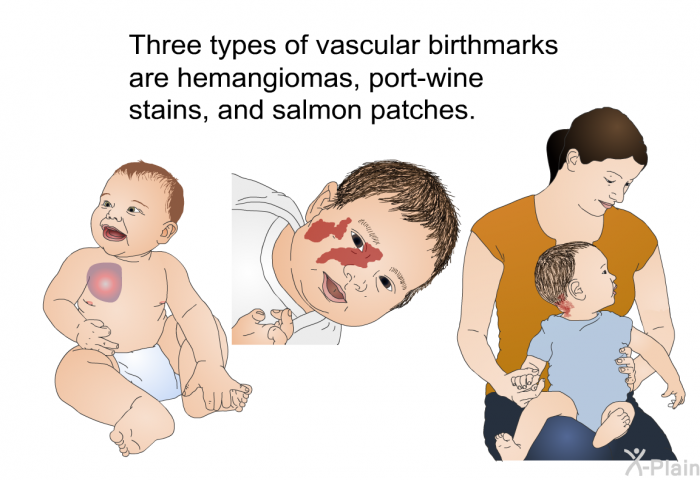 Three types of vascular birthmarks are hemangiomas, port-wine stains, and salmon patches.