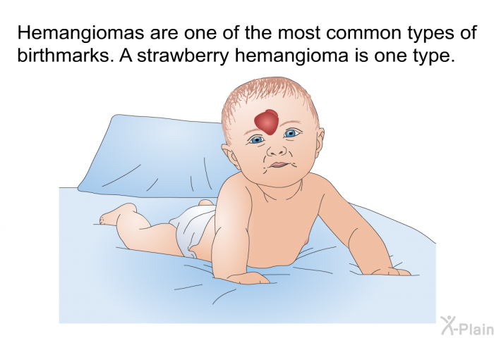 Hemangiomas are one of the most common types of birthmarks. A strawberry hemangioma is one type.