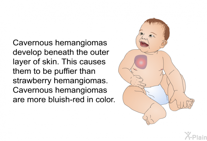 Cavernous hemangiomas develop beneath the outer layer of skin. This causes them to be puffier than strawberry hemangiomas. Cavernous hemangiomas are more bluish-red in color.