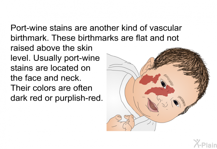 Port-wine stains are another kind of vascular birthmark. These birthmarks are flat and not raised above the skin level. Usually port-wine stains are located on the face and neck. Their colors are often dark red or purplish-red.
