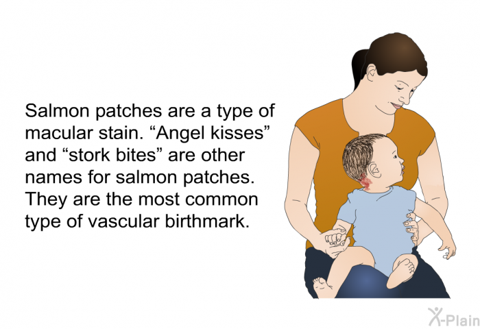 Salmon patches are a type of macular stain. “Angel kisses” and “stork bites” are other names for salmon patches. They are the most common type of vascular birthmark.