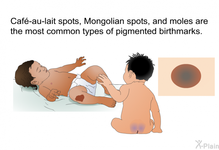 Caf-au-lait spots, Mongolian spots, and moles are the most common types of pigmented birthmarks.