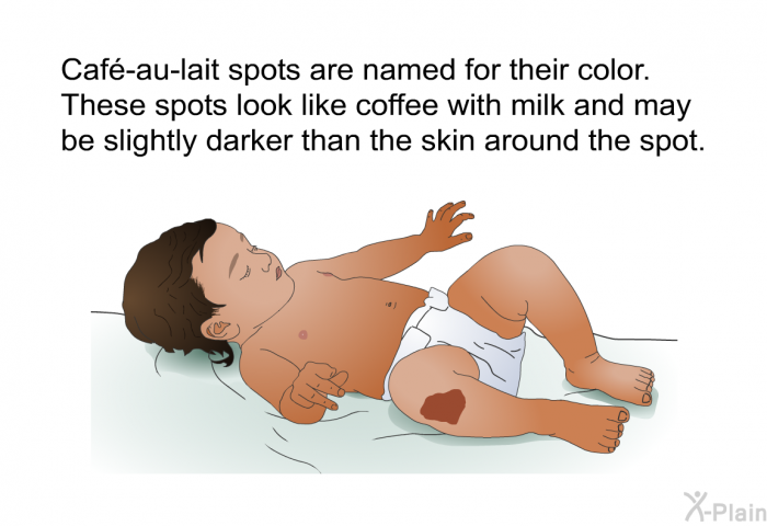 Caf-au-lait spots are named for their color. These spots look like coffee with milk and may be slightly darker than the skin around the spot.