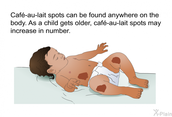 Caf-au-lait spots can be found anywhere on the body. As a child gets older, caf-au-lait spots may increase in number.