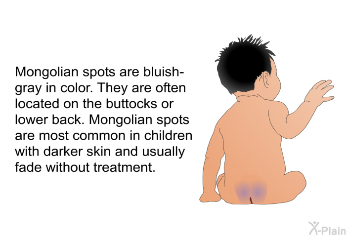 Mongolian spots are bluish-gray in color. They are often located on the buttocks or lower back. Mongolian spots are most common in children with darker skin and usually fade without treatment.