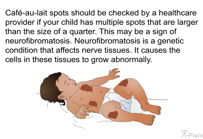 Caf�-au-lait spots should be checked by a healthcare provider if your child has multiple spots that are larger than the size of a quarter. This may be a sign of neurofibromatosis. Neurofibromatosis is a genetic condition that affects nerve tissues. It causes the cells in these tissues to grow abnormally.