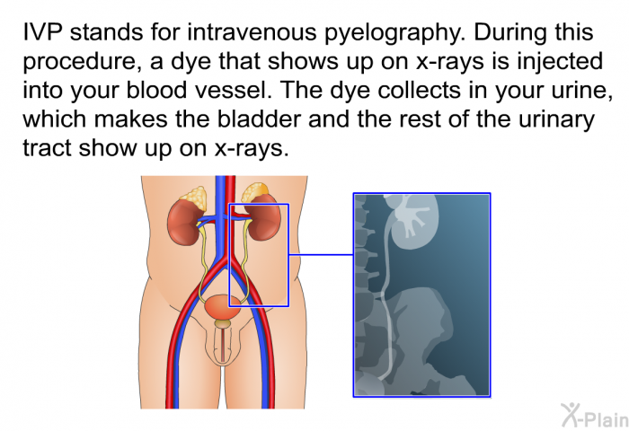 IVP stands for intravenous pyelography. During this procedure, a dye that shows up on x-rays is injected into your blood vessel. The dye collects in your urine, which makes the bladder and the rest of the urinary tract show up on x-rays.