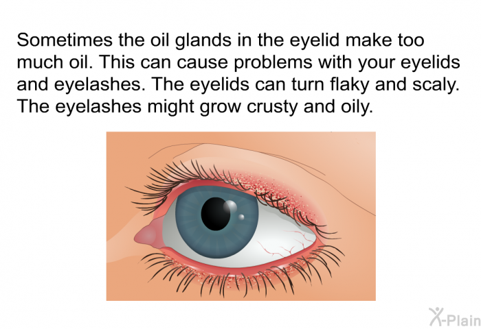 Sometimes the oil glands in the eyelid make too much oil. This can cause problems with your eyelids and eyelashes. The eyelids can turn flaky and scaly. The eyelashes might grow crusty and oily.
