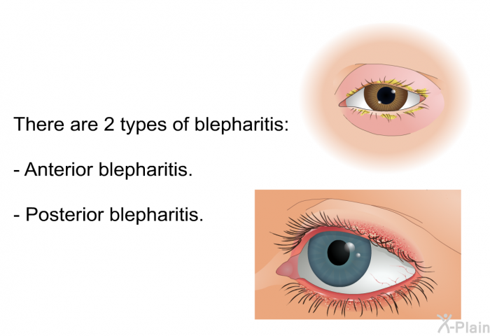 There are 2 types of blepharitis:  Anterior blepharitis. Posterior blepharitis.