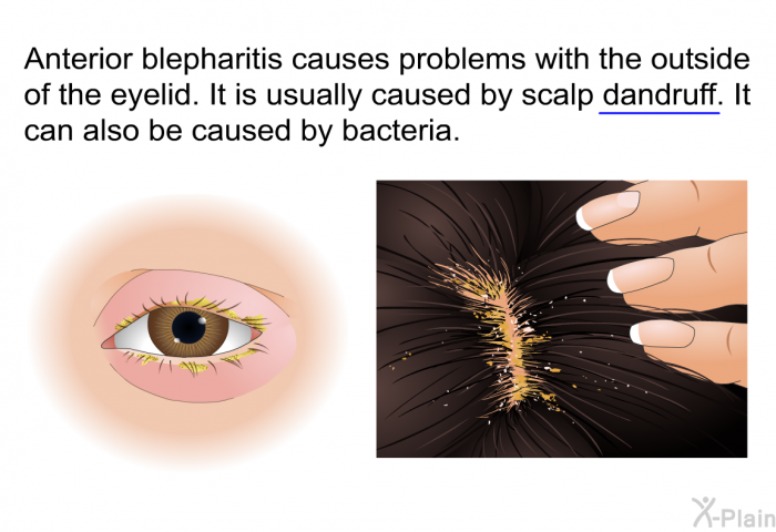 Anterior blepharitis causes problems with the outside of the eyelid. It is usually caused by scalp dandruff. It can also be caused by bacteria.