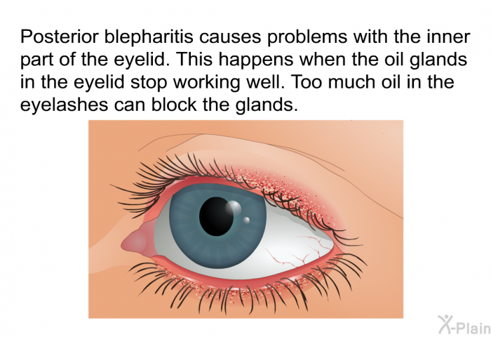 Posterior blepharitis causes problems with the inner part of the eyelid. This happens when the oil glands in the eyelid stop working well. Too much oil in the eyelashes can block the glands.