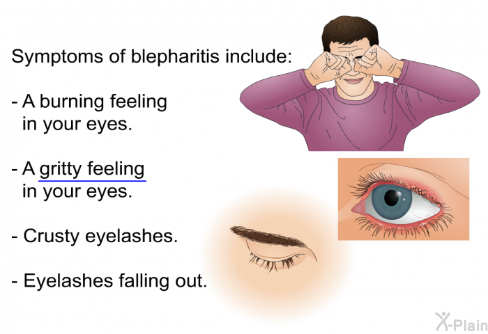 Symptoms of blepharitis include:  A burning feeling in your eyes. A gritty feeling in your eyes. Crusty eyelashes. Eyelashes falling out.