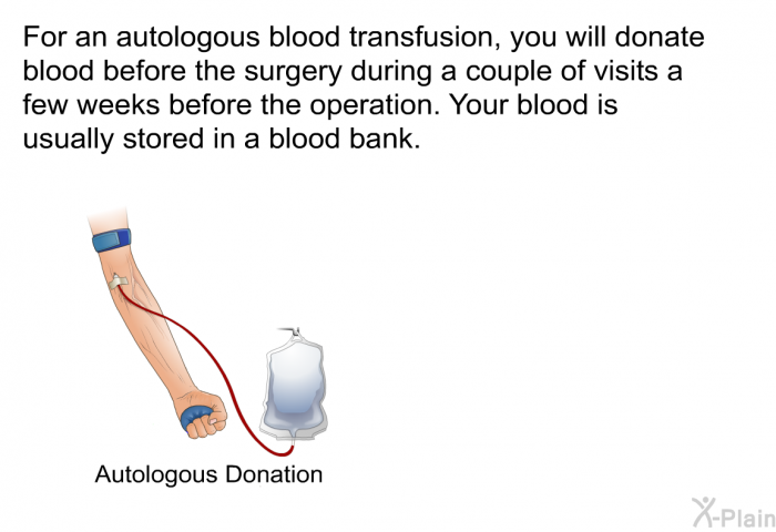 For an autologous blood transfusion, you will donate blood before the surgery during a couple of visits a few weeks before the operation. Your blood is usually stored in a blood bank.