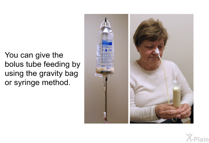 You can give the bolus tube feeding by using the gravity bag or syringe method.