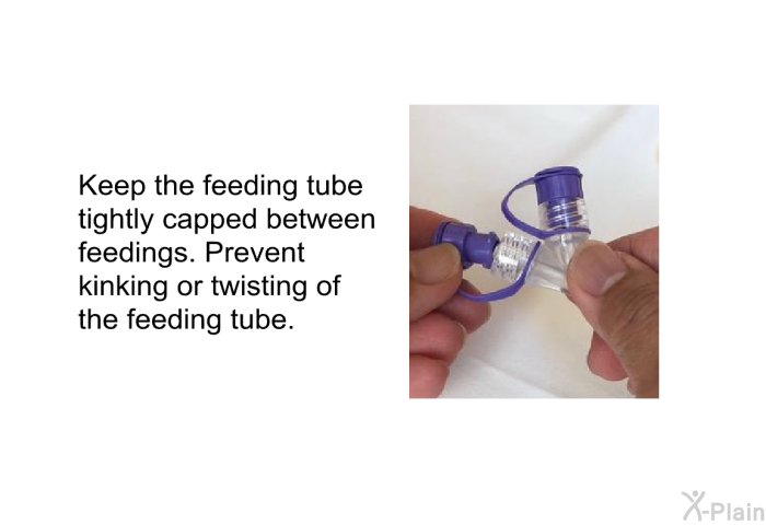 Keep the feeding tube tightly capped between feedings. Prevent kinking or twisting of the feeding tube.