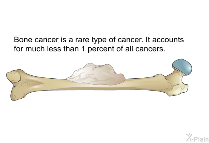 Bone cancer is a rare type of cancer. It accounts for much less than 1 percent of all cancers.