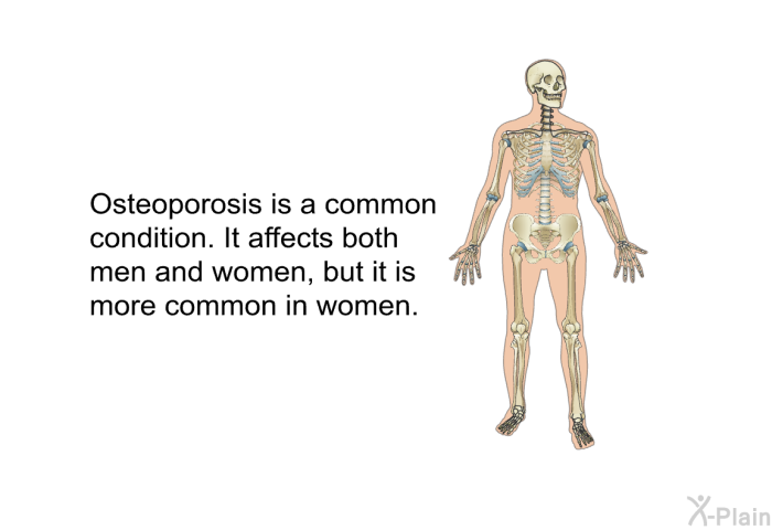 Osteoporosis is a common condition. It affects both men and women, but it is more common in women.