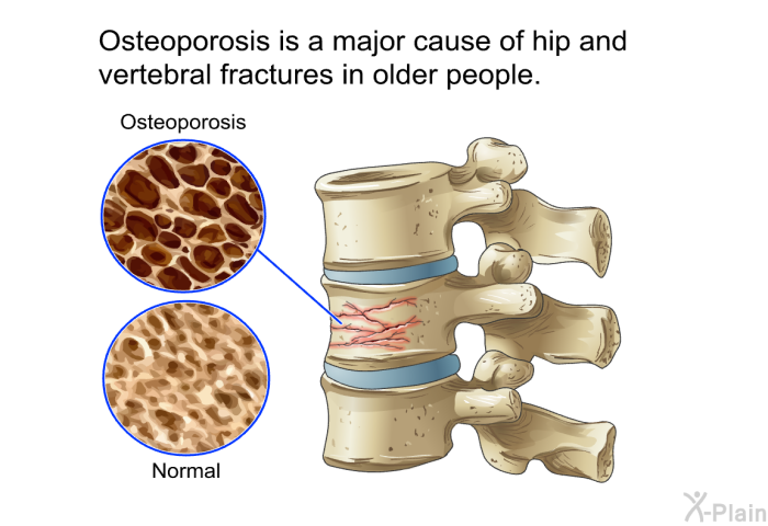 Osteoporosis is a major cause of hip and vertebral fractures in older people.