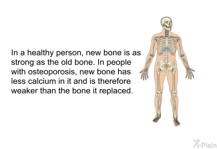 In a healthy person, new bone is as strong as the old bone. In people with osteoporosis, new bone has less calcium in it and is therefore weaker than the bone it replaced.