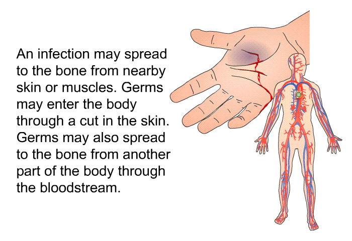 An infection may spread to the bone from nearby skin or muscles. Germs may enter the body through a cut in the skin. Germs may also spread to the bone from another part of the body through the bloodstream.