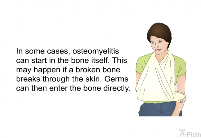 In some cases, osteomyelitis can start in the bone itself. This may happen if a broken bone breaks through the skin. Germs can then enter the bone directly.