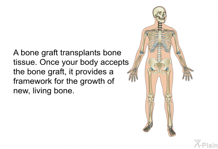 A bone graft transplants bone tissue. Once your body accepts the bone graft, it provides a framework for the growth of new, living bone.