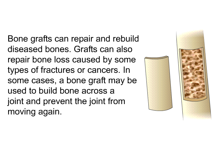 Bone grafts can repair and rebuild diseased bones. Grafts can also repair bone loss caused by some types of fractures or cancers. In some cases, a bone graft may be used to build bone across a joint and prevent the joint from moving again.