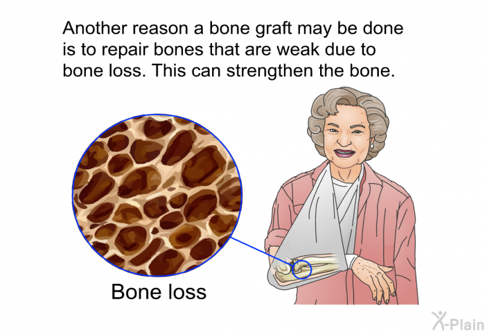 Another reason a bone graft may be done is to repair bones that are weak due to bone loss. This can strengthen the bone.