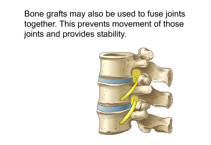 Bone grafts may also be used to fuse joints together. This prevents movement of those joints and provides stability.