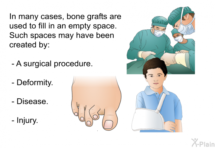 In many cases, bone grafts are used to fill in an empty space. Such spaces may have been created by:  A surgical procedure. Deformity. Disease. Injury.