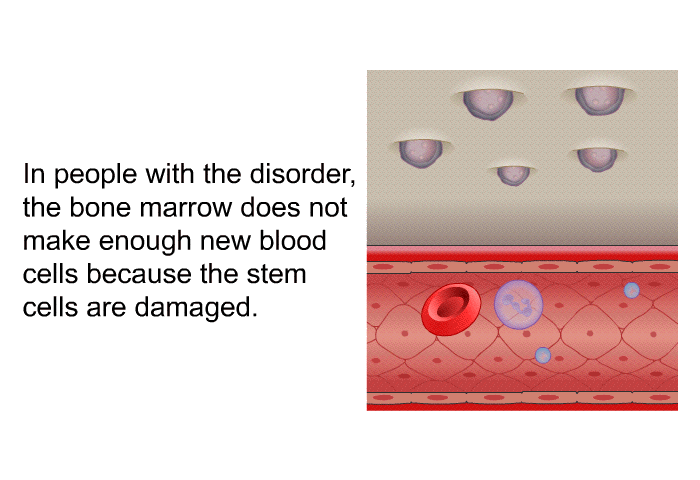 In people with the disorder, the bone marrow does not make enough new blood cells because the stem cells are damaged.