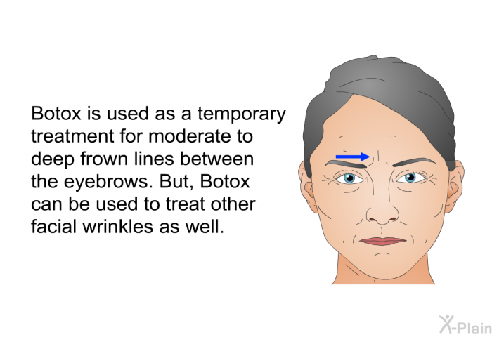 Botox is used as a temporary treatment for moderate to deep frown lines between the eyebrows. But, Botox can be used to treat other facial wrinkles as well.