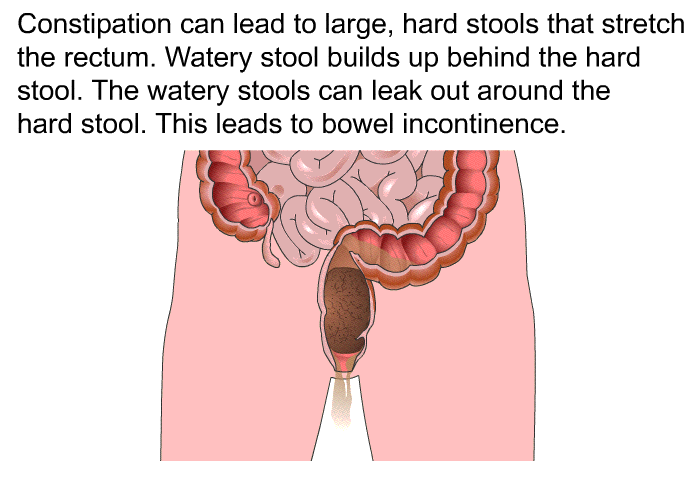Constipation can lead to large, hard stools that stretch the rectum. Watery stool builds up behind the hard stool. The watery stools can leak out around the hard stool. This leads to bowel incontinence.