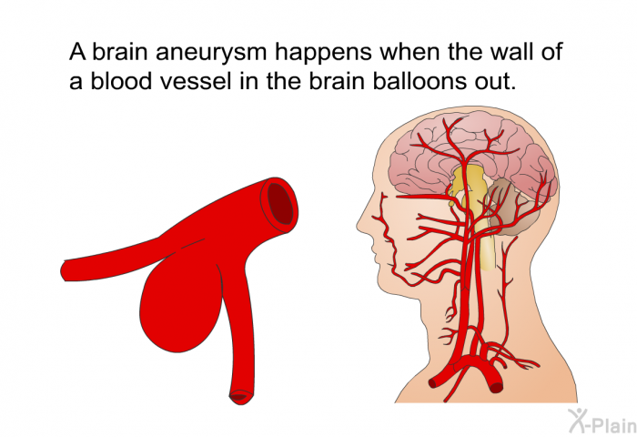 A brain aneurysm happens when the wall of a blood vessel in the brain balloons out.