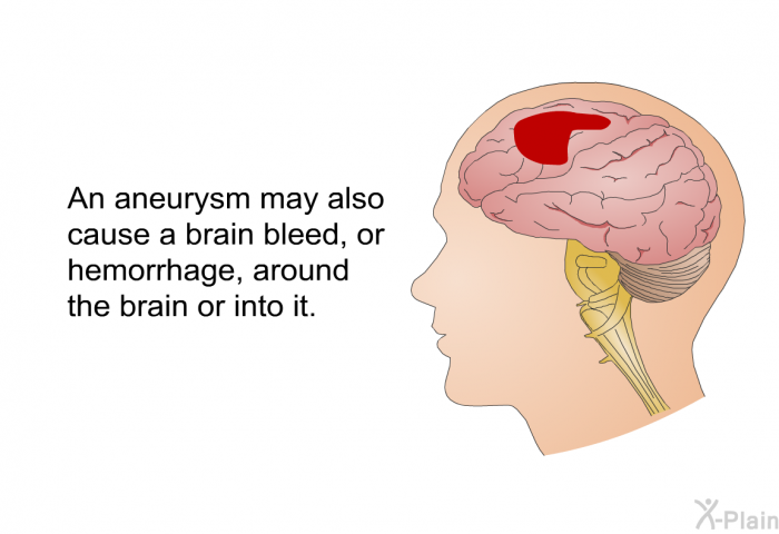 An aneurysm may also cause a brain bleed, or hemorrhage, around the brain or into it.