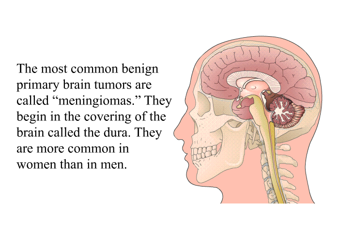 The most common benign primary brain tumors are called “meningiomas.” They begin in the covering of the brain called the dura. They are more common in women than in men.