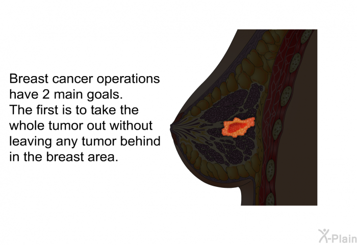 Breast cancer operations have 2 main goals. The first is to take the whole tumor out without leaving any tumor behind in the breast area.