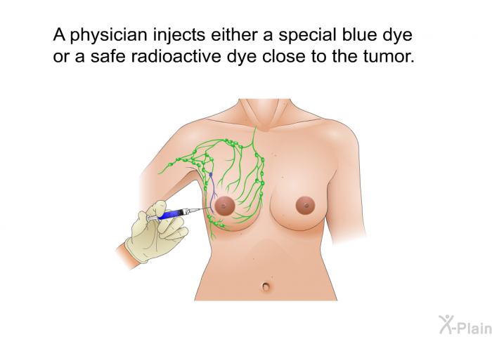 A physician injects either a special blue dye or a safe radioactive dye close to the tumor.