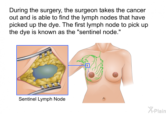 During the surgery, the surgeon takes the cancer out and is able to find the lymph nodes that have picked up the dye. The first lymph node to pick up the dye is known as the "sentinel node."