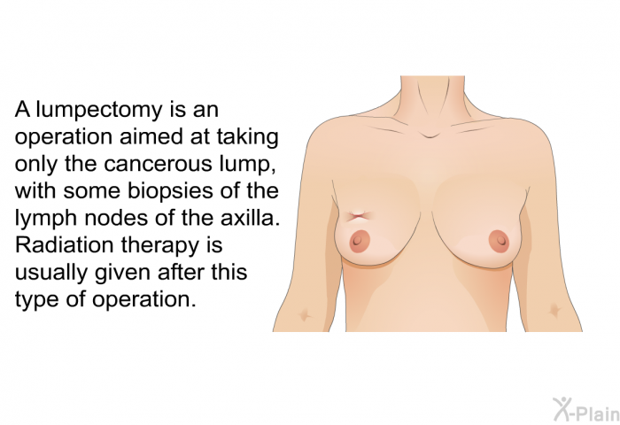 A lumpectomy is an operation aimed at taking only the cancerous lump, with some biopsies of the lymph nodes of the axilla. Radiation therapy is usually given after this type of operation.