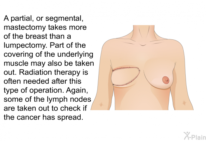 A partial, or segmental, mastectomy takes more of the breast than a lumpectomy. Part of the covering of the underlying muscle may also be taken out. Radiation therapy is often needed after this type of operation. Again, some of the lymph nodes are taken out to check if the cancer has spread.